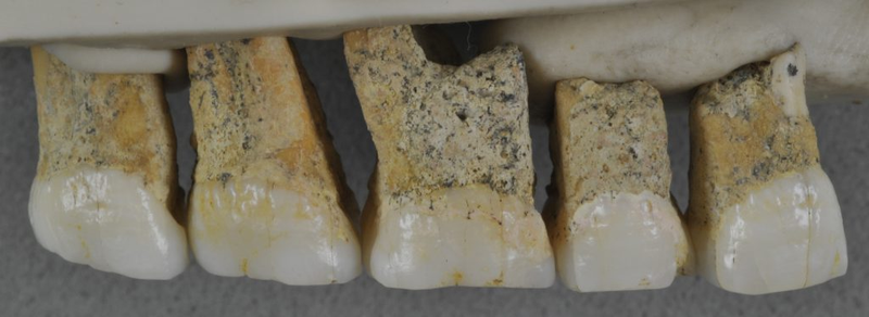 Five upper teeth of the newly described human species, Homo luzonensis.